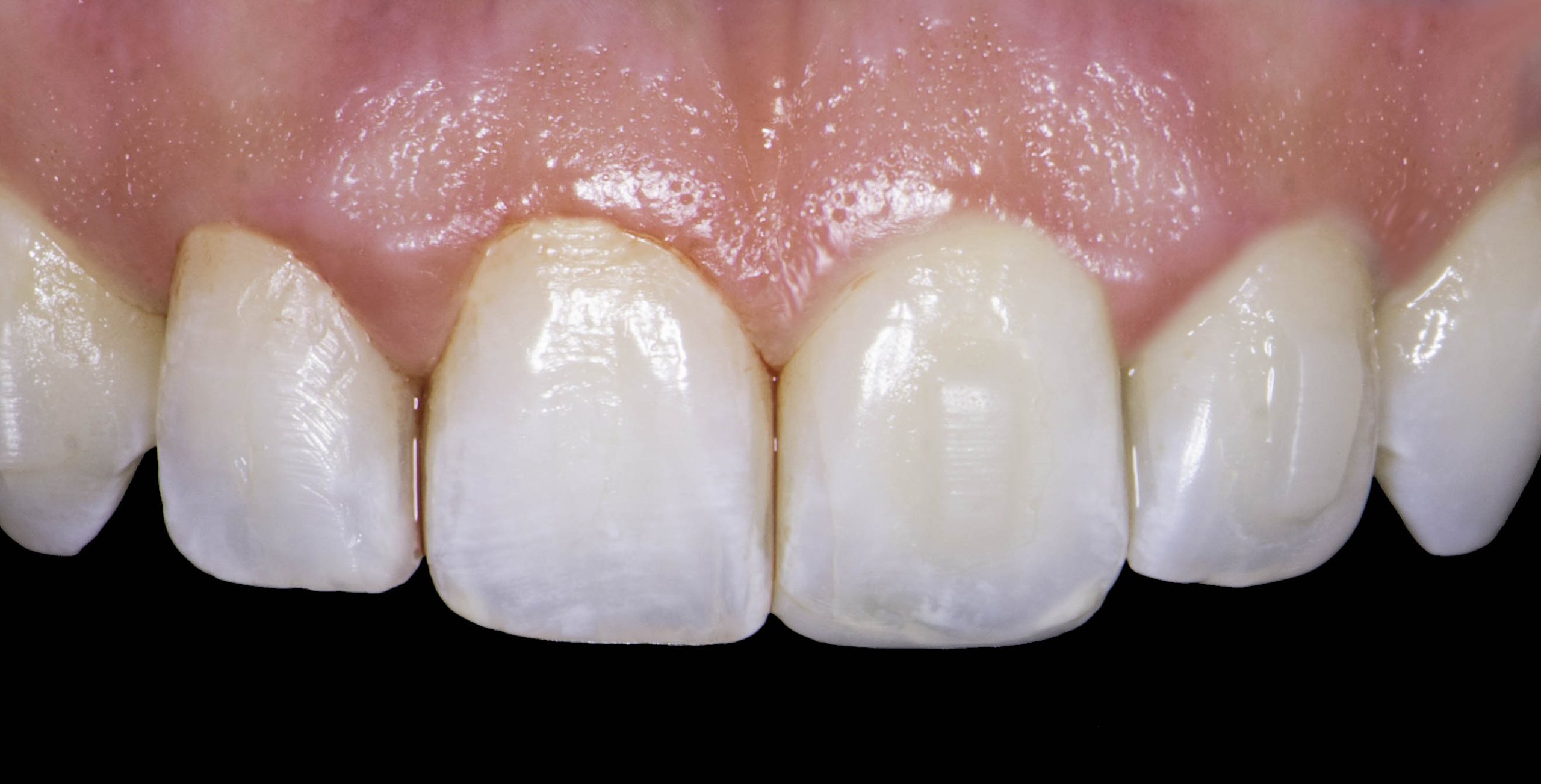 Mejora de sonrisa rápida y sencilla