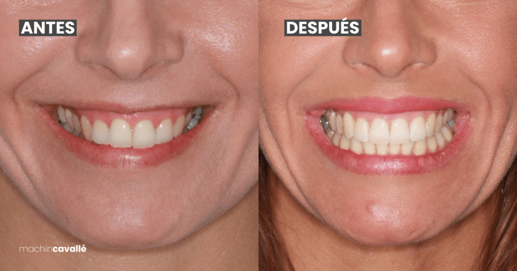 caso real invisalign
