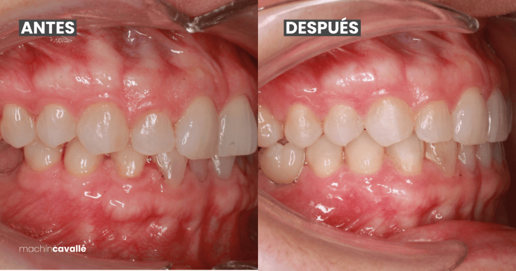 resultado invisalign