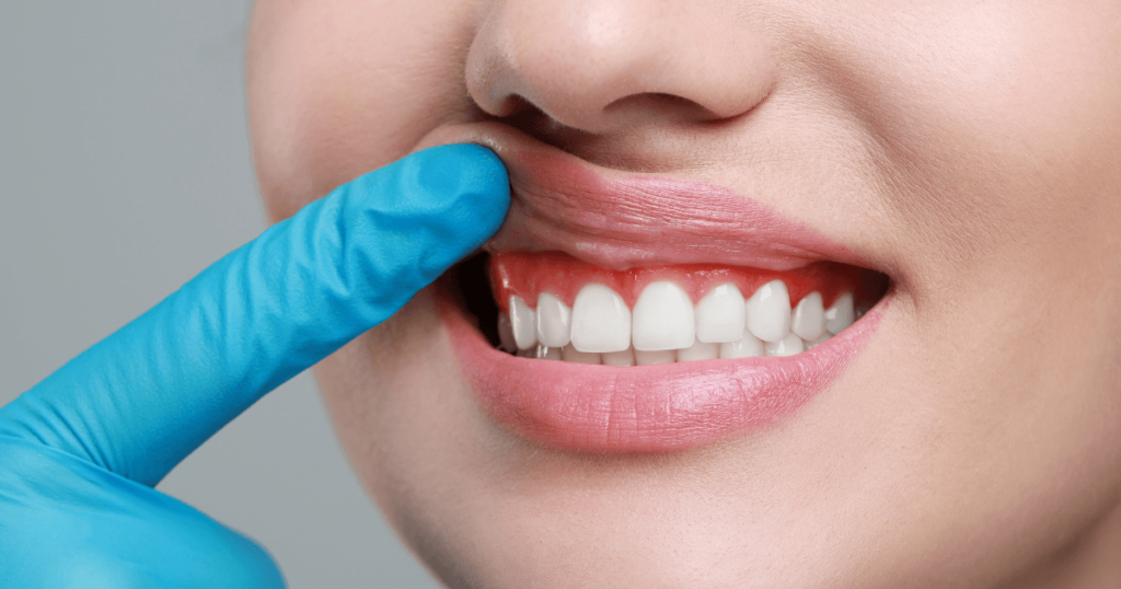 inflamación en las encías y gingivitis