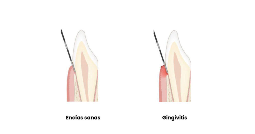 Encía sana frente a encía con gingivitis