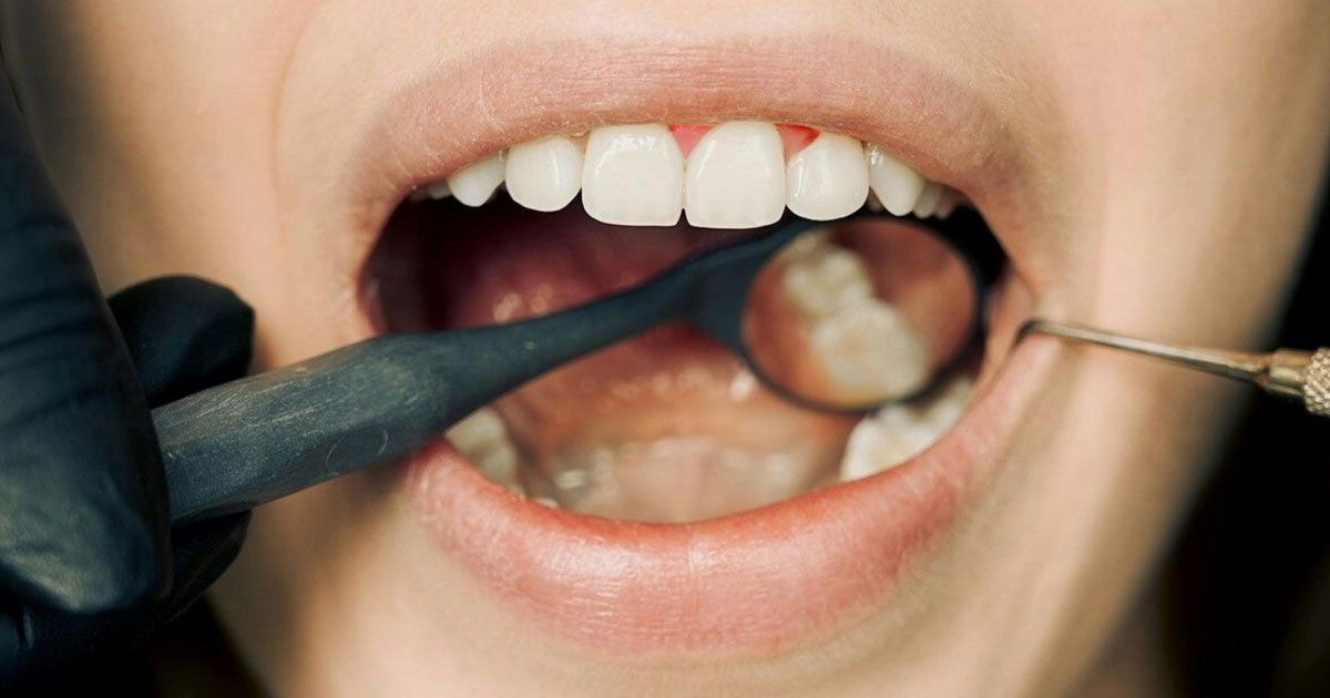 Gingivitis
