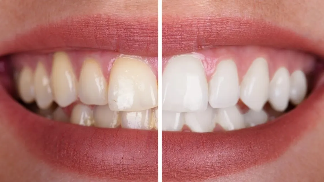 Blanqueamiento dental en Oviedo