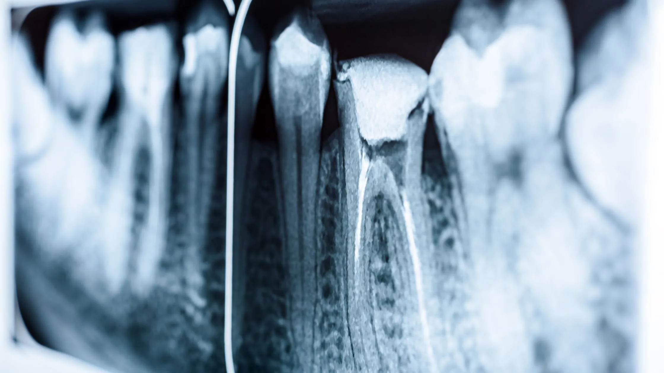 Endodoncia