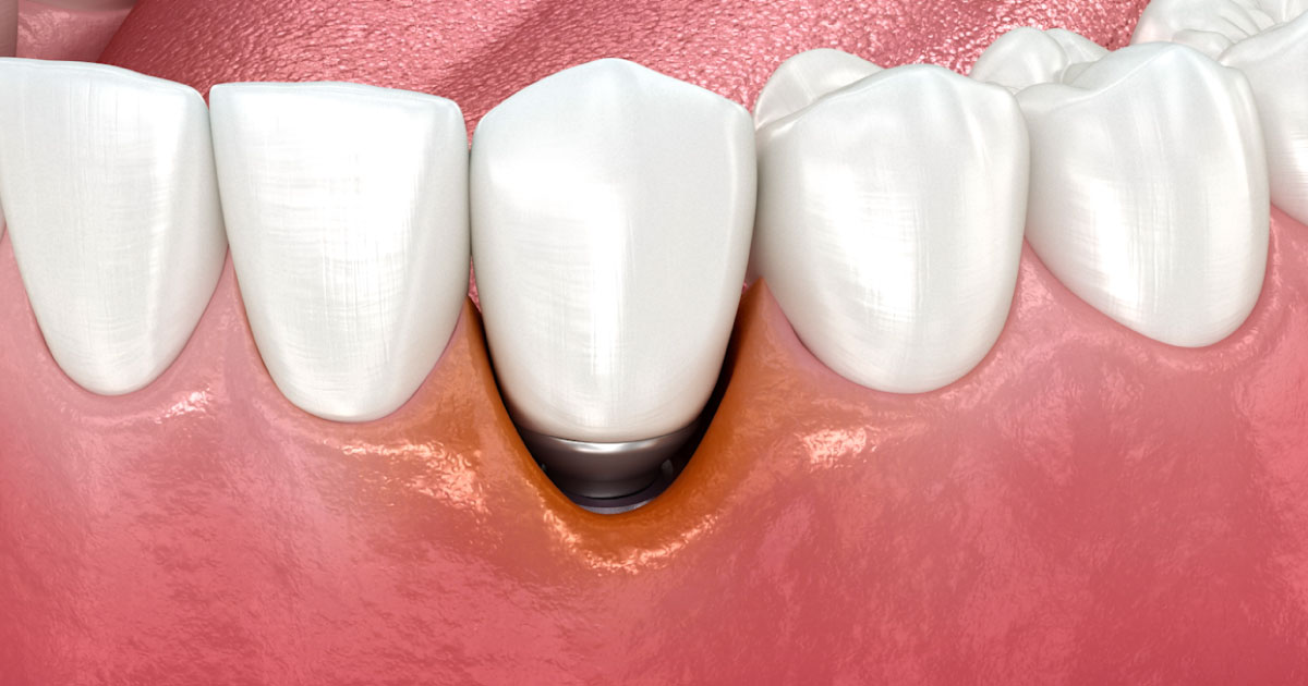 Periimplantitis, detectarla y tratarla a tiempo