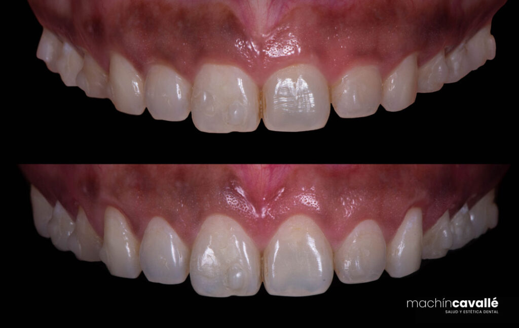 Tratamiento de sonrisa gingival en Machín Cavallé