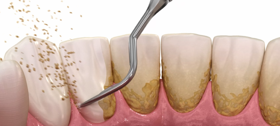 Limpieza dental con ultrasonido
