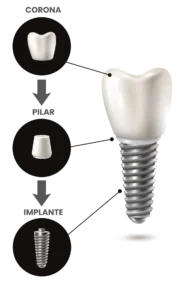 Partes de un implante dental
