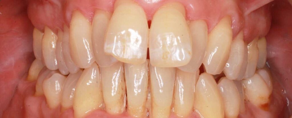 Apiñamiento dental moderado