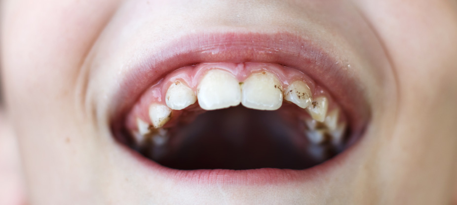 Manchas en los dientes