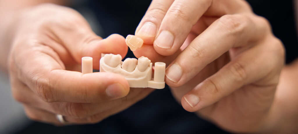 Corona dental en la clínica dental Machín Cavallé