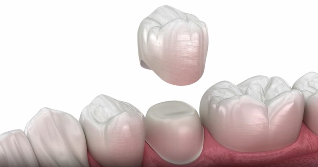 Colocación de corona dental
