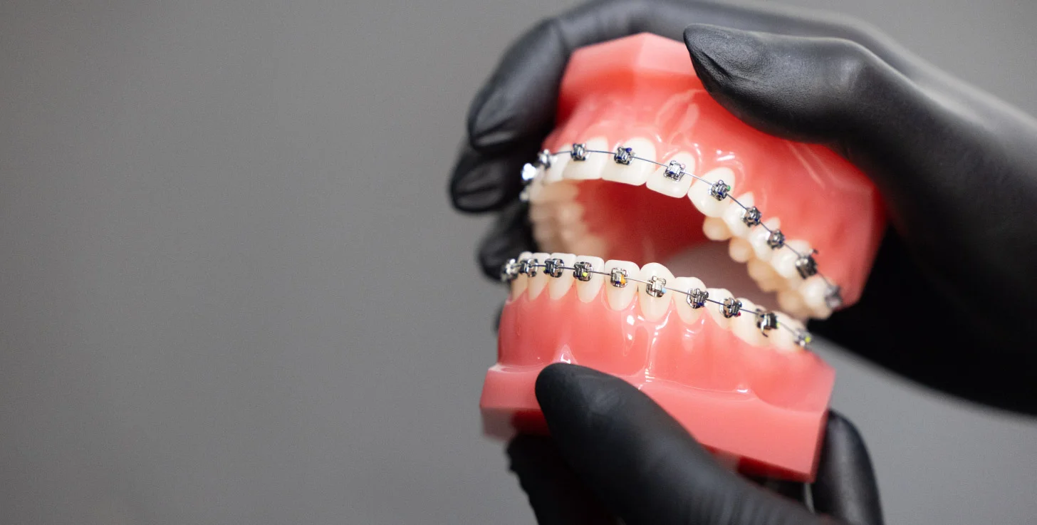 Ortodoncia con brackets en Oviedo