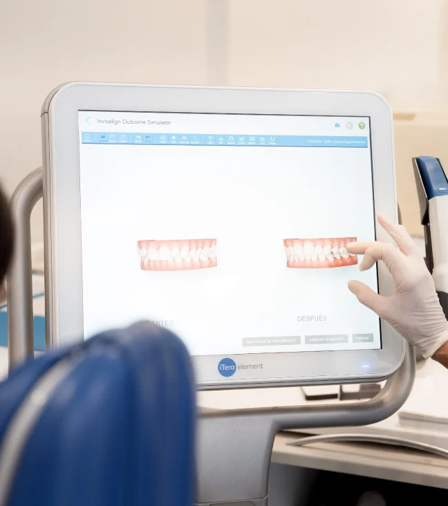 Simulación de sonrisa en ortodoncia invisible