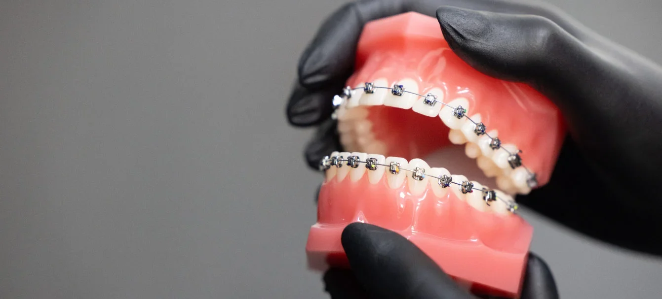 Ortodoncia con brackets